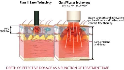 grade 4 laser therapy